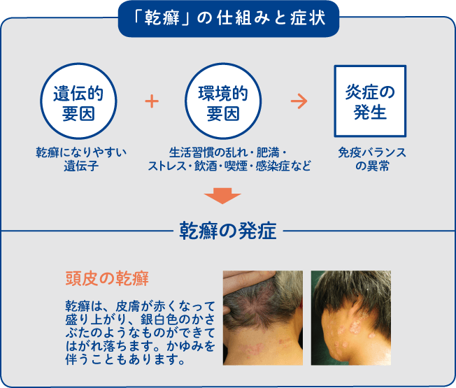 今から知る ここから変わる 乾癬 患者さんが気持ちよく来店できる美容室へ 乾癬パートナーズ