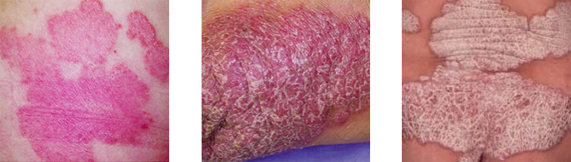 尋常性乾癬の皮膚症状の例：紅斑、肥厚、鱗屑