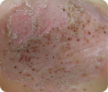 写真_掌蹠膿疱症の皮疹