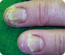 写真_爪や足の甲、膝などにも症状が現れることがあります