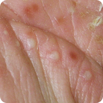 写真_膿疱・痂疲