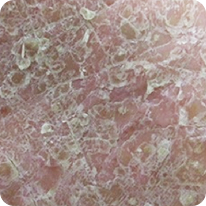 写真_鱗屑・落屑