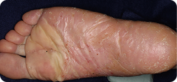 写真_歯性病巣感染治療の治療前