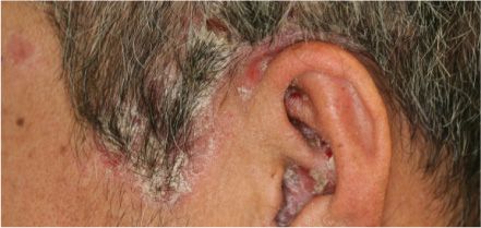 頭皮と耳にできた乾癬