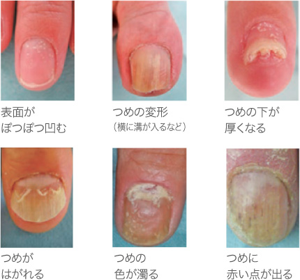 表面がぽつぽつ凹む・つめの変形(横に溝が入るなど)・つめの下が厚くなる・つめがはがれる・つめの色が濁る・つめに赤い点が出る