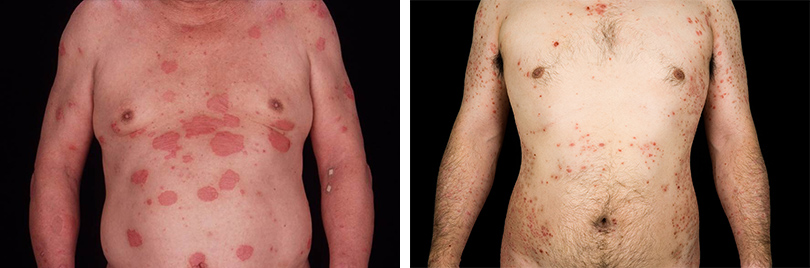 尋常性乾癬の皮膚症状の例：体前部の皮疹