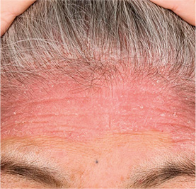 尋常性乾癬の皮膚症状の例:生え際の皮疹